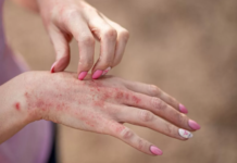 Swędzenie skóry i wysypki: jak odróżnić dermatozy ciążowe od zwykłych alergii